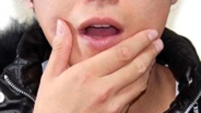 Denti del giudizio: quando e perché è meglio toglierli