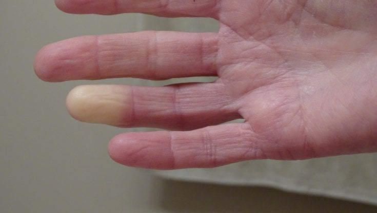 Sclerodermia, non dimentichiamo i polmoni