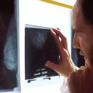 Mammografia a 40 anni per personalizzare lo screening