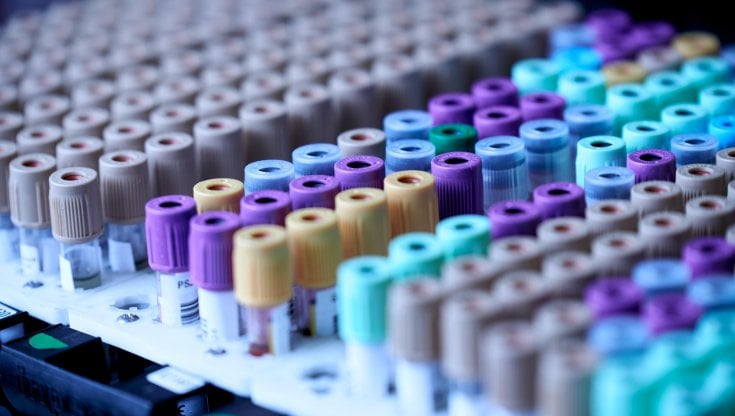 Alzheimer, la diagnosi con un test del sangue potrebbe essere più vicina