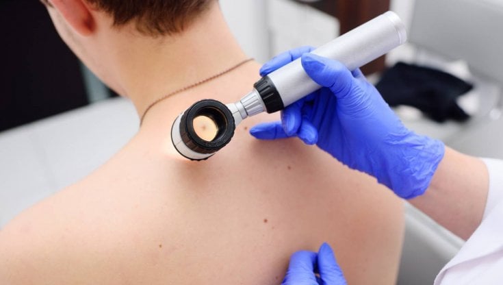 Melanoma: dieci raccomandazioni per la diagnosi precoce 