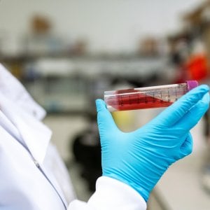 Linfoma a grandi cellule B, una nuova terapia all’orizzonte
