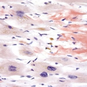 Amiloidosi cardiaca, che cos'è e quali sono i segnali d'allarme per distinguerla dallo scompenso
