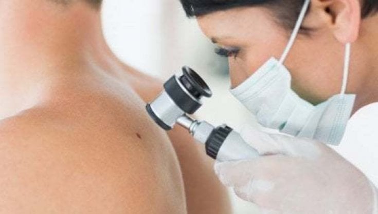 Prevenzione, parliamo di melanoma