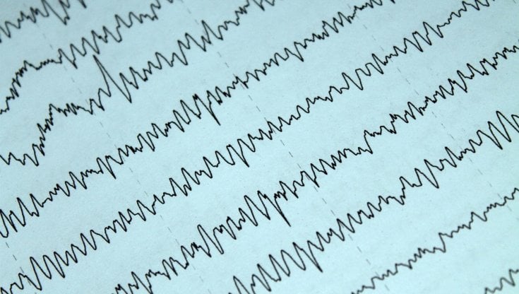 Coma e ictus, l’Ai prevede le possibilità di recupero dei pazienti