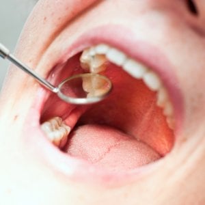 Quando vanno tolti i denti del giudizio?