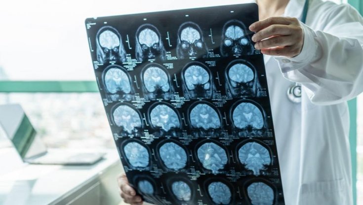Disturbi neurologici, la mappa dei rischi e come evitarli