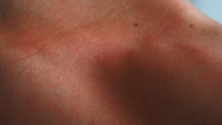 Dermatite atopica, screening gratuito a Roma