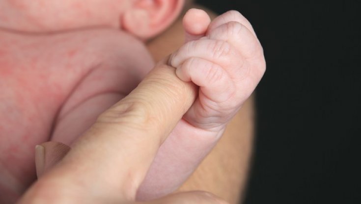 Bimbi pretermine: bene la sopravvivenza, ma il 90% soffre di disfagia 