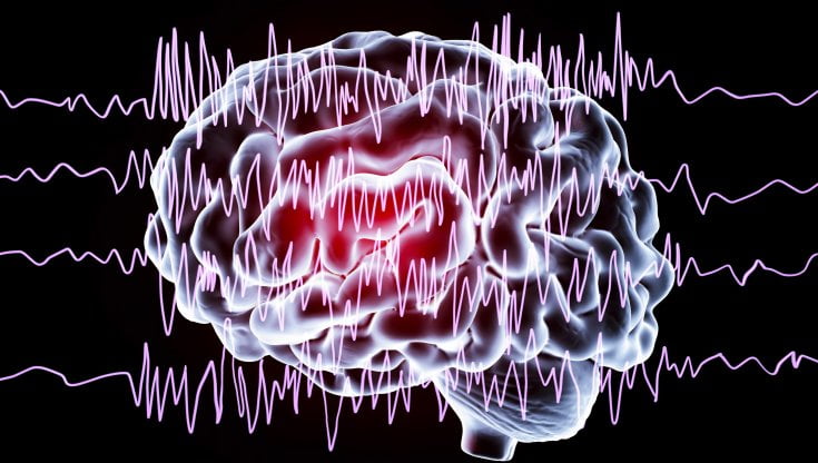 Epilessia, come si riconosce e come si interviene in caso di una crisi