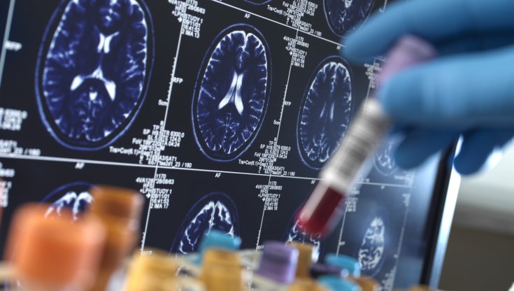Dai farmaci anti-obesità una speranza contro l'Alzheimer e il Parkinson