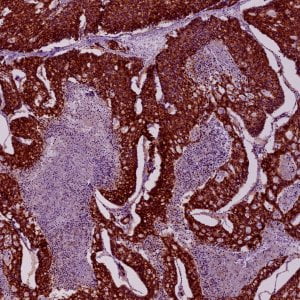Cancro al pancreas: in ogni paziente tante cellule tumorali differenti complicano le terapie