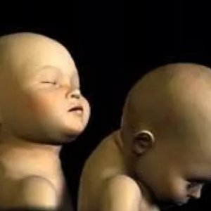 Sarsılmış bebek sendromu, birkaç saniye süren bir hareketin çok ciddi sonuçlara yol açabileceği durum