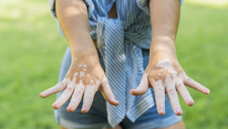 Vitiligine, ok di AIFA a rimborsabilità prima crema efficace