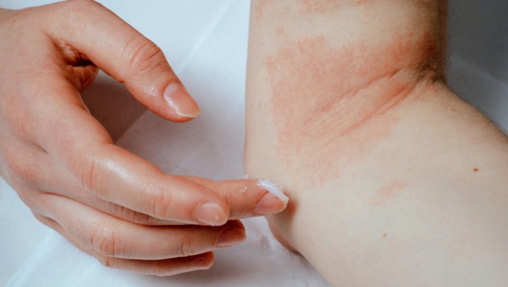 Allarme dei dermatologi: "L'inquinamento colpisce duramente la pelle"