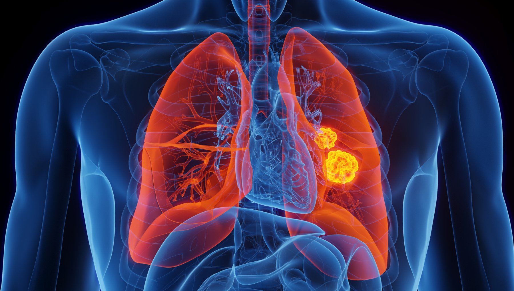 Cancer du poumon, feu vert européen à une thérapie ciblée pour réduire