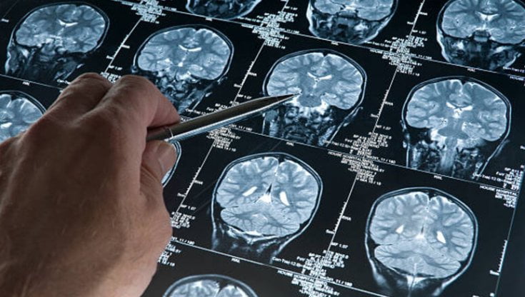 Un dispositivo nel cervello per curare l'epilessia, primo intervento su un 12enne