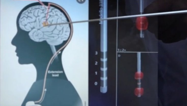 Parkinson: scoperta nuova mutazione genetica associata a morbo