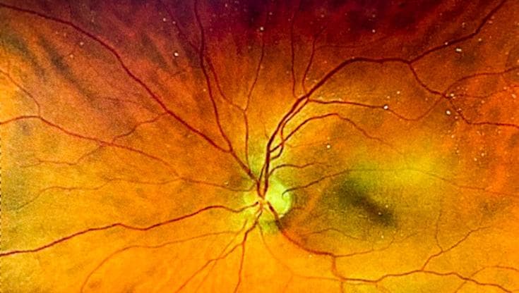Retina: l’occlusione della vena centrale può provocare maculopatia?