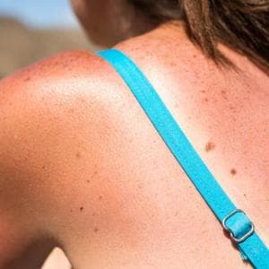 Avvelenamento da sole, cosa accade quando la tintarella va oltre la semplice scottatura