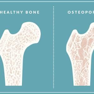 Osteoporoz, kendinizi kırılgan kemiklerden nasıl korursunuz