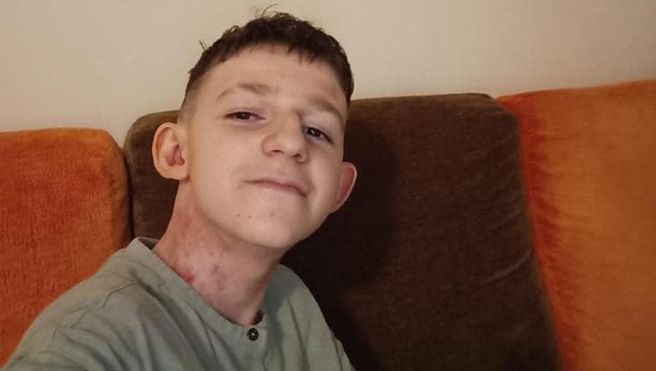 Alex, il “ragazzo farfalla” che entrerà nella sperimentazione di trapianto di pelle