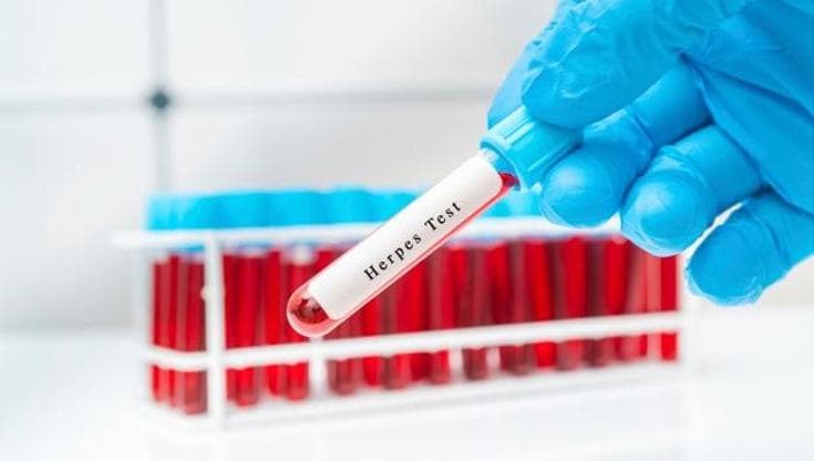 Un under 50 su cinque vive con l’herpes genitale