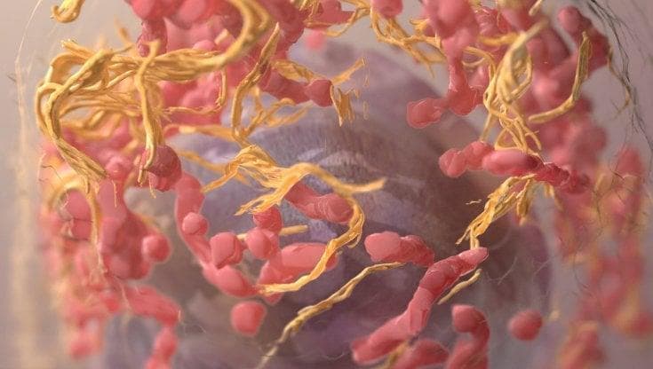 Melanoma, il vaccino terapeutico riduce il rischio di metastasi