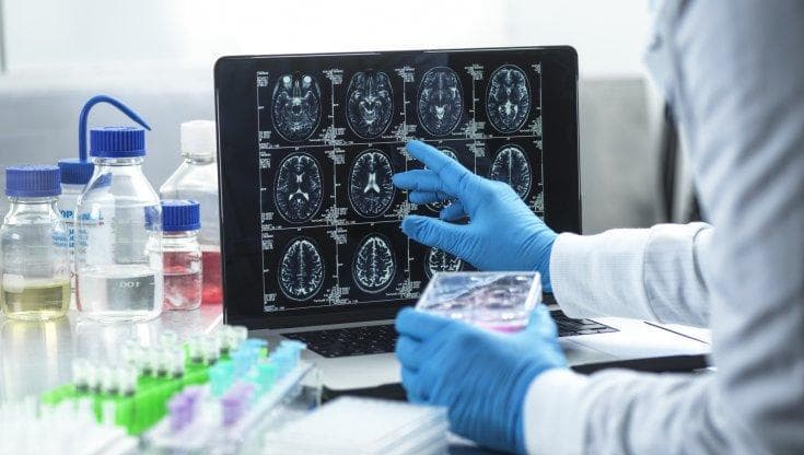 Prove incoraggianti per un vaccino contro il glioblastoma