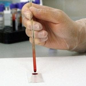 Un test del sangue promette di scoprire i tumori in anticipo