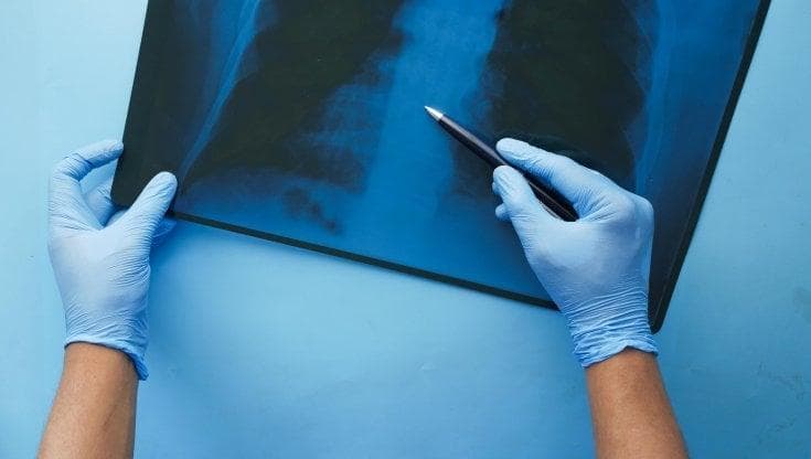 Tumore al polmone, AIFA approva la rimborsabilità di amivantamab