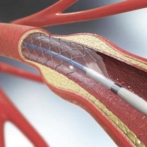 Prevenzione dell’ictus, riparazione delle valvole: cosa si può fare con la cardiologia interventistica
