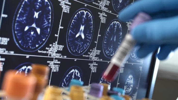 Farmaco contro l'Alzheimer ritirato dal mercato