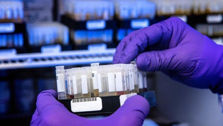 Sclerosi multipla, così il virus Epstein-Barr potrebbe aiutare a scatenare la malattia