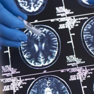 Alzheimer, sì della Fda al farmaco che blocca la malattia precoce