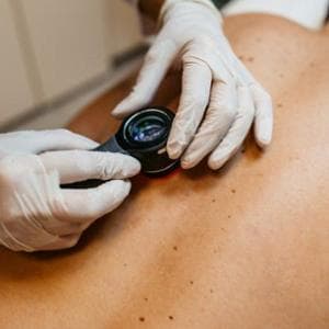 Melanoma: l’immunoterapia prima dell’intervento funziona