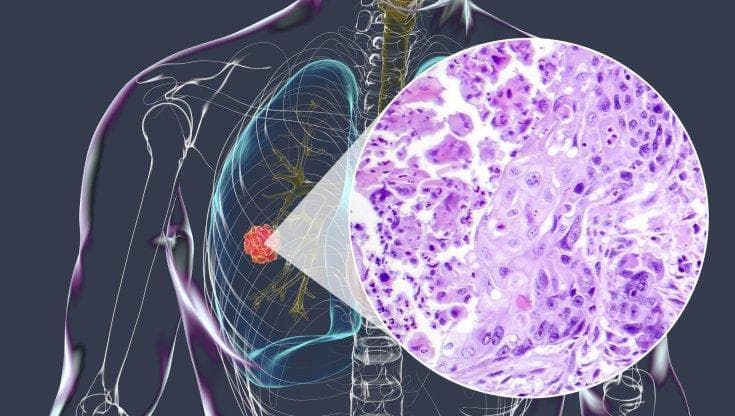 Tumore del polmone, si conferma il ruolo dell'immunoterapia
