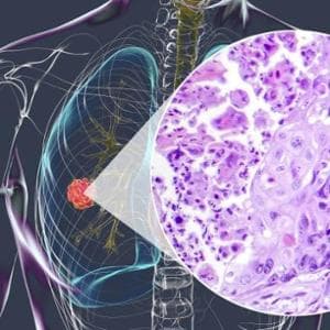 Tumore del polmone, si conferma il ruolo dell'immunoterapia