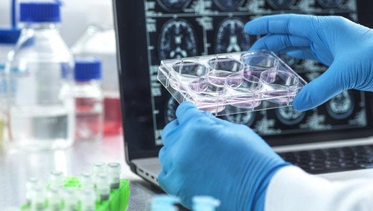 Alzheimer, approvazione più vicina per una nuova terapia