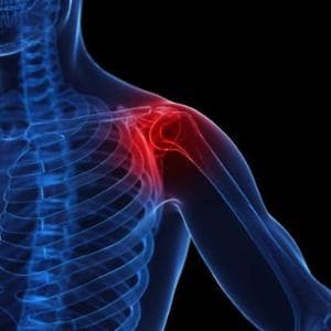 Cuffia dei rotatori, cosa è e come si curano le lesioni?