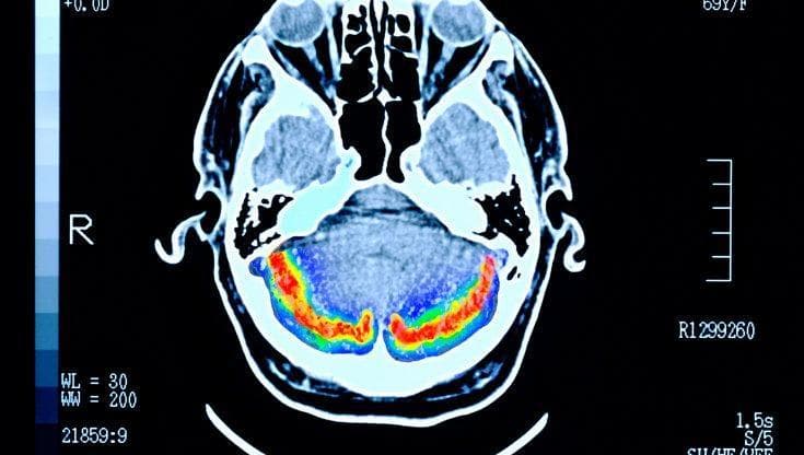 L'Alzheimer non è uno solo: scoperte 5 forme diverse