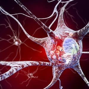 Demenza, scoperti i due biomarcatori chiave: un esame della saliva porta a galla la malattia