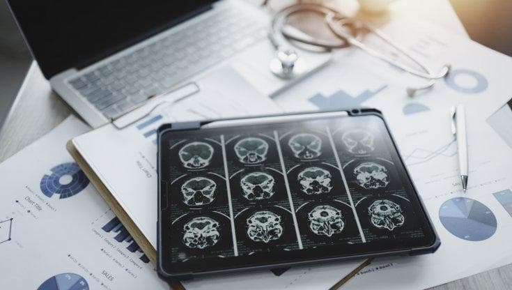 Stimolazione transcranica precoce per rallentare i sintomi dell’Alzheimer