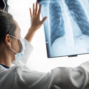 Tumore del polmone, una nuova terapia mirata al posto della chemio