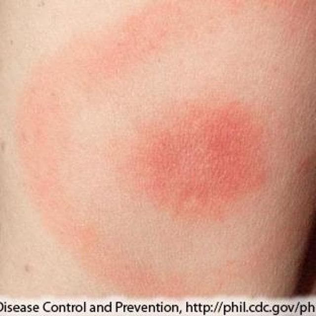 Malattia di Lyme, cosa fare se morde una zecca