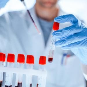 Una firma molecolare per la leucemia aggressiva