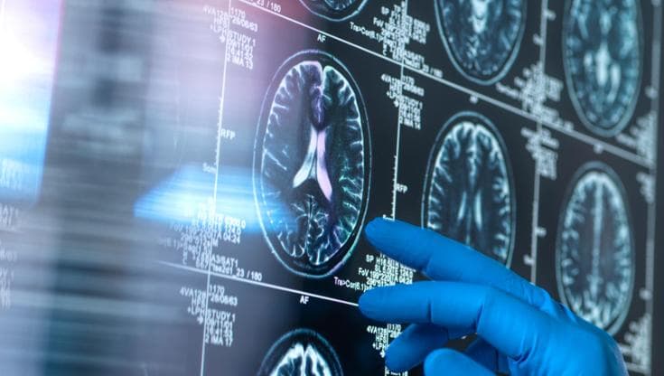 Alzheimer, tanti i fattori che possono scatenarlo. E c’entra (anche) la politica