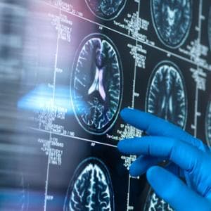 Alzheimer, Bilim anıların GP'lerini açar. Ancak yardım için herhangi bir fon ve yasa yok