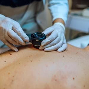 Melanoma, nei giovani è il terzo tumore
