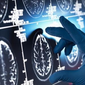 İtalya'da yapılan bir çalışma Alzheimer hastalığının ilerlemesinde anahtar bir mekanizmayı ortaya koyuyor